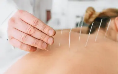 How Many Dry Needling Sessions for Piriformis Syndrome?