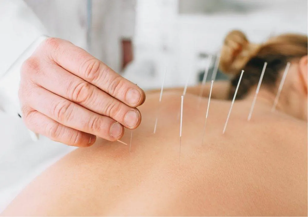 Dry-Needling-1
